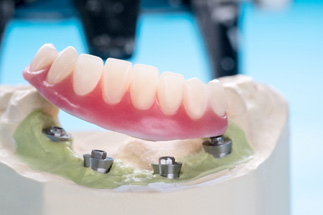 Cast of lower arch with 4 implant posts and a lower arch of dentures