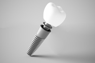A digital image of a single tooth dental implant