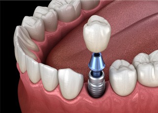 An aging gentleman admiring his new dental implant