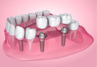 An aging gentleman admiring his new dental implant