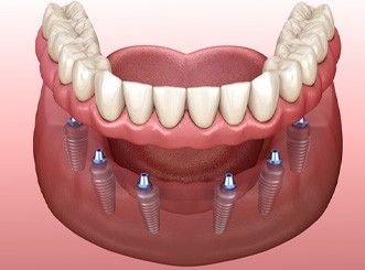 An aging gentleman admiring his new dental implant
