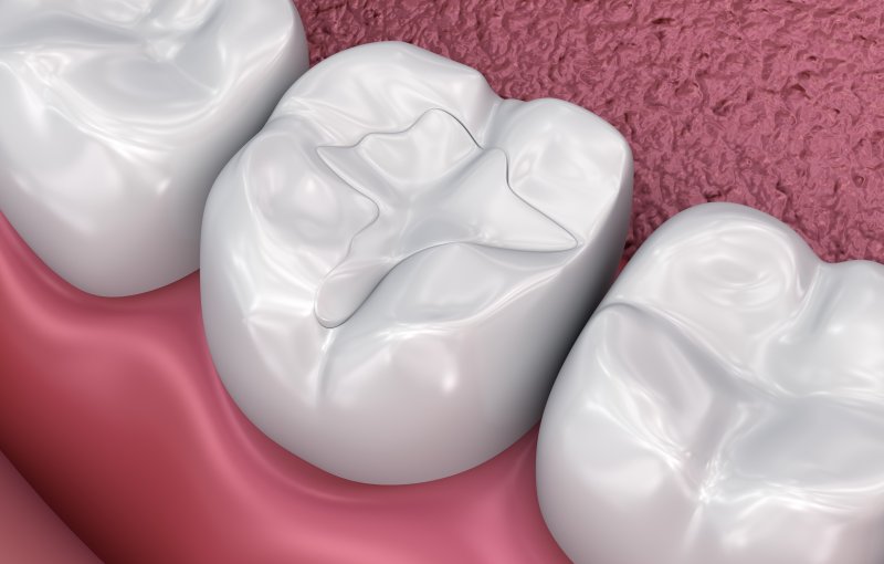A zoomed-in, 3D illustration of a dental filling