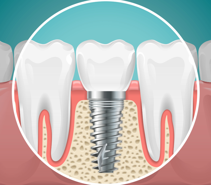 Illustrated cross section of a dental implant